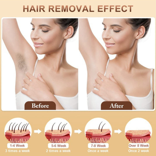 Appareil d'epilation laser IPL